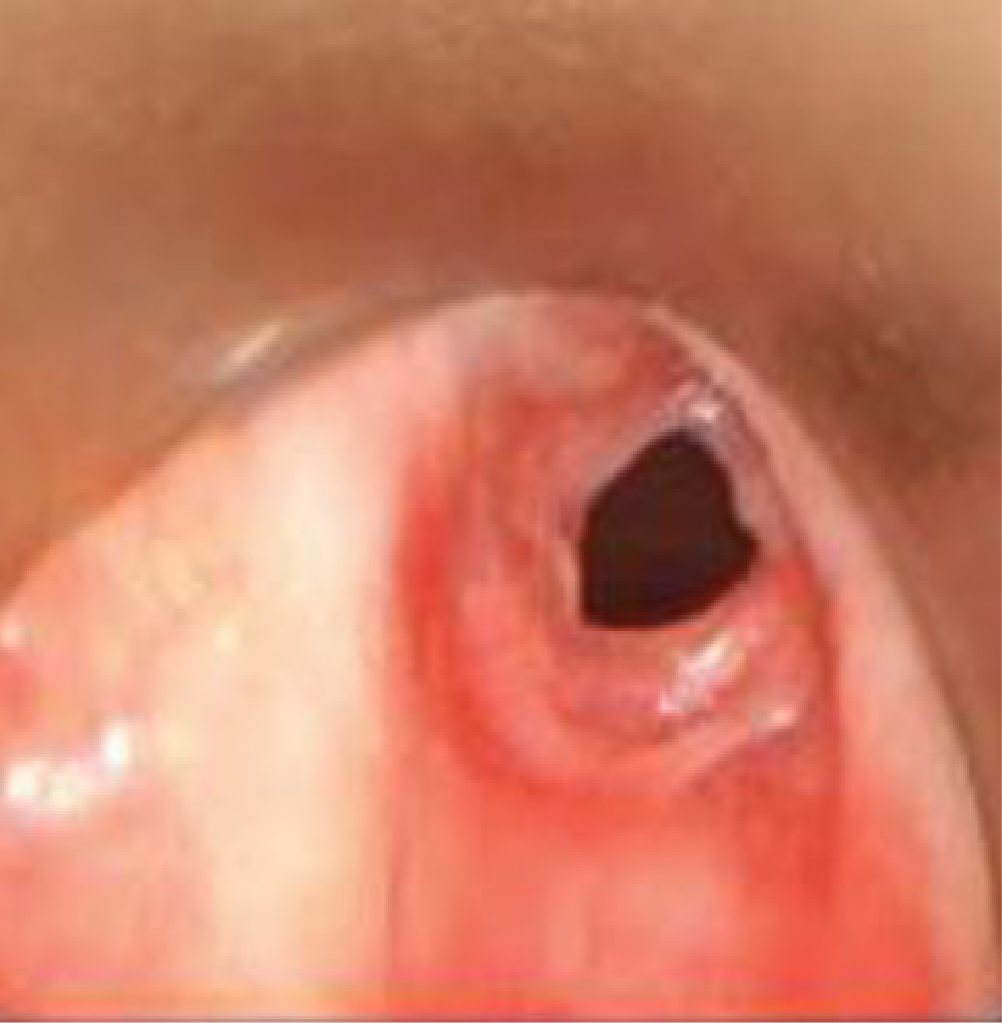 /GPA/MPA symptoms: ENT - Subglottic stenosis