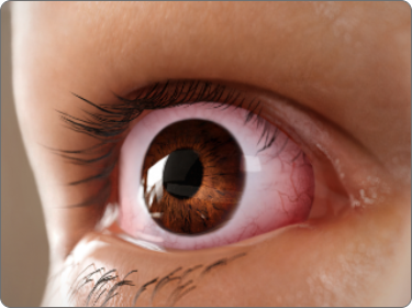 Eyelid retraction