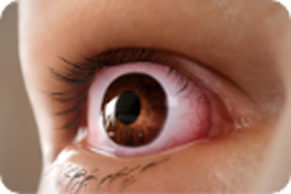 upper eyelid retraction