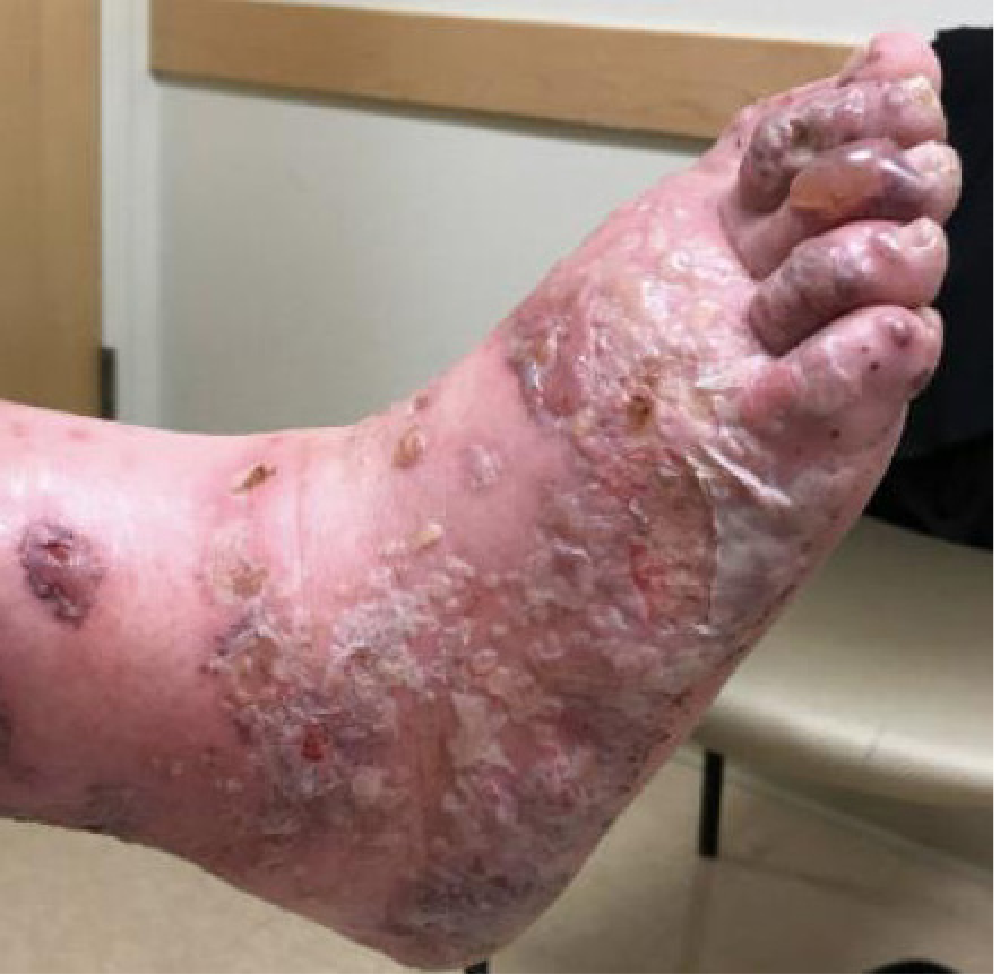 GPA/MPA symptoms: Severe skin disease with deep ulcerations