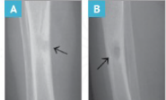 osteomyelitis-cgd-xray-image-mobile