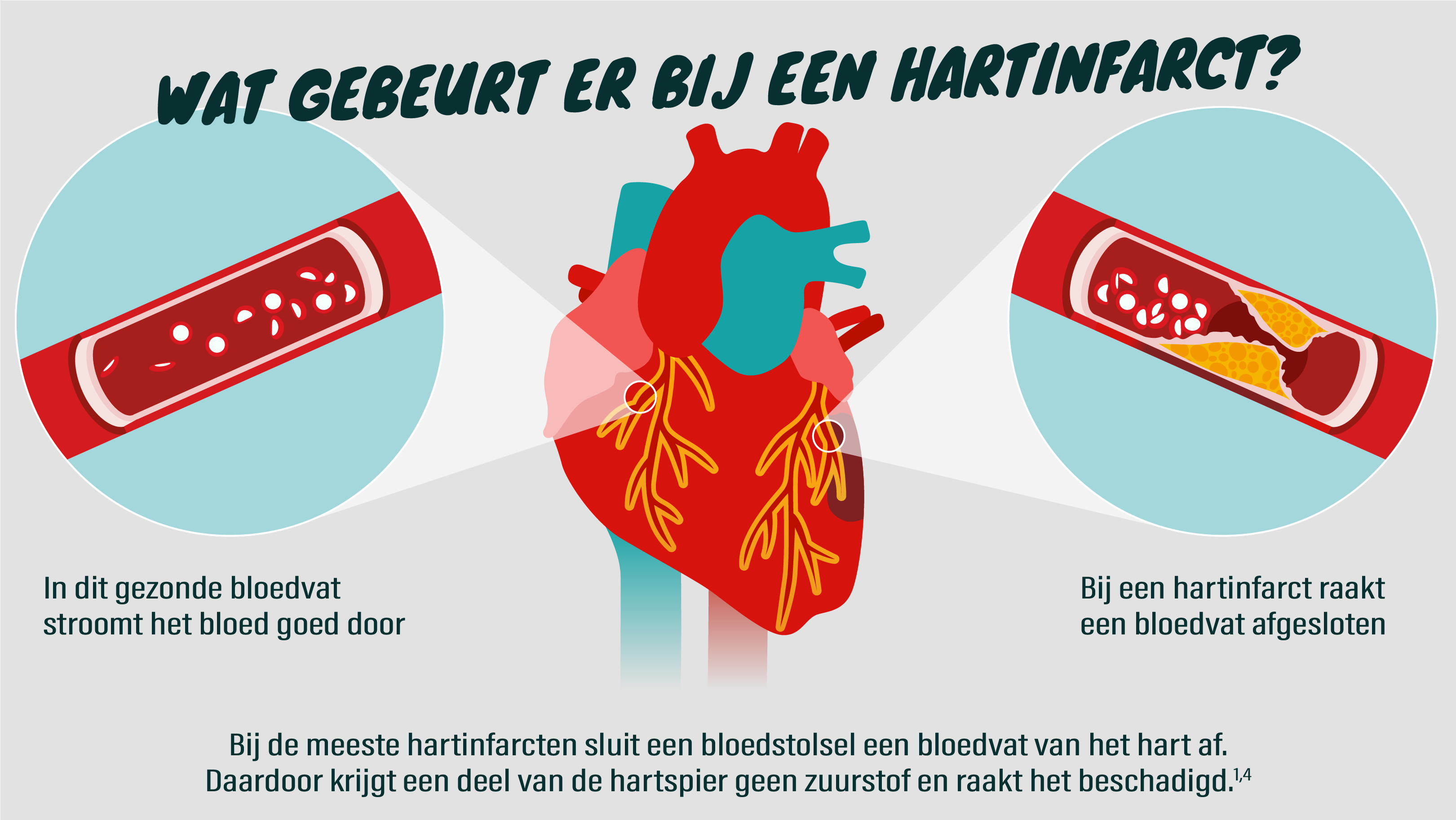 Een hart met een verstopte ader door atherosclerose.