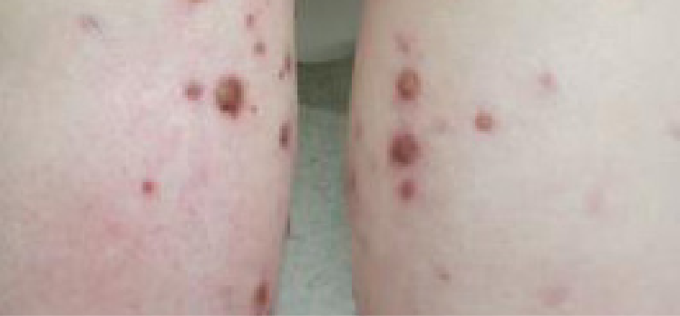 GPA/MPA symptoms: Severe skin purpura