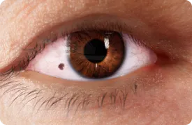 something-stuck-in-the-eye-rendering