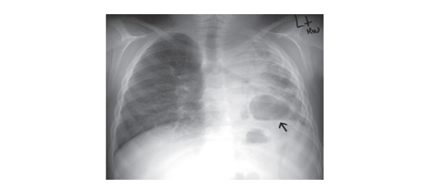 pulmonary-infection-cgd-xray-image
