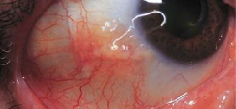 Eye examination revealing scleritis