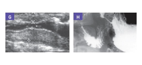 gastric-outlet-obstruction-cgd-imaging-mobile