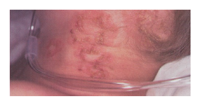 vesicular-lesions-x-linked-cgd-neck-mobile