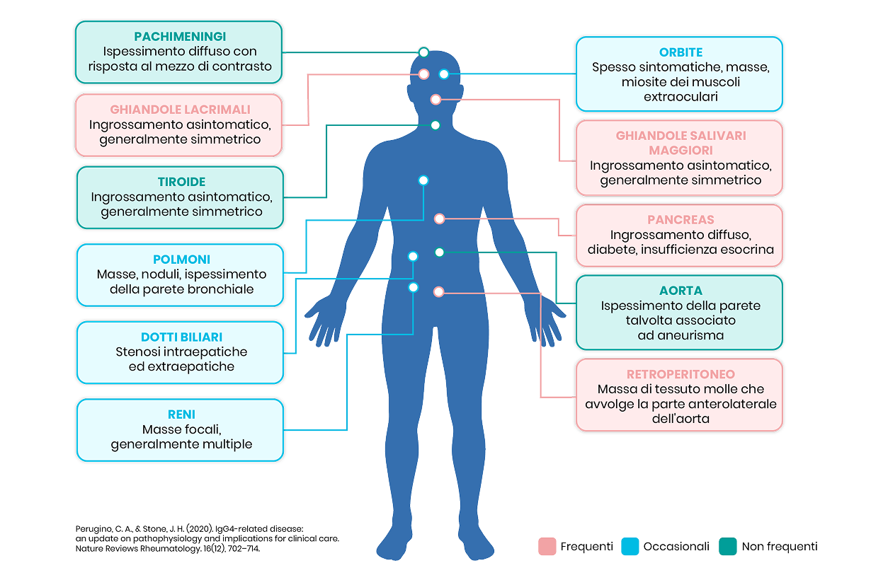 Infografica anatomica: Infografica anatomica che illustra i distretti corporei che possono essere coinvolti dalla malattia IgG4-correlata, classificati per frequenza.