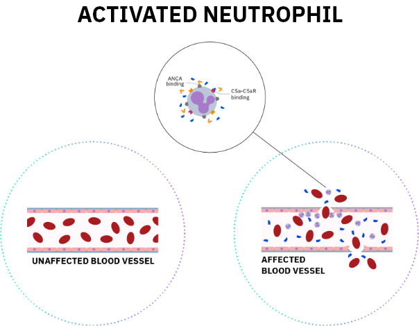 Severe active GPA and MPA characterized by neutrophil-induced inflammation and scarring of small-to-medium vessel endothelia