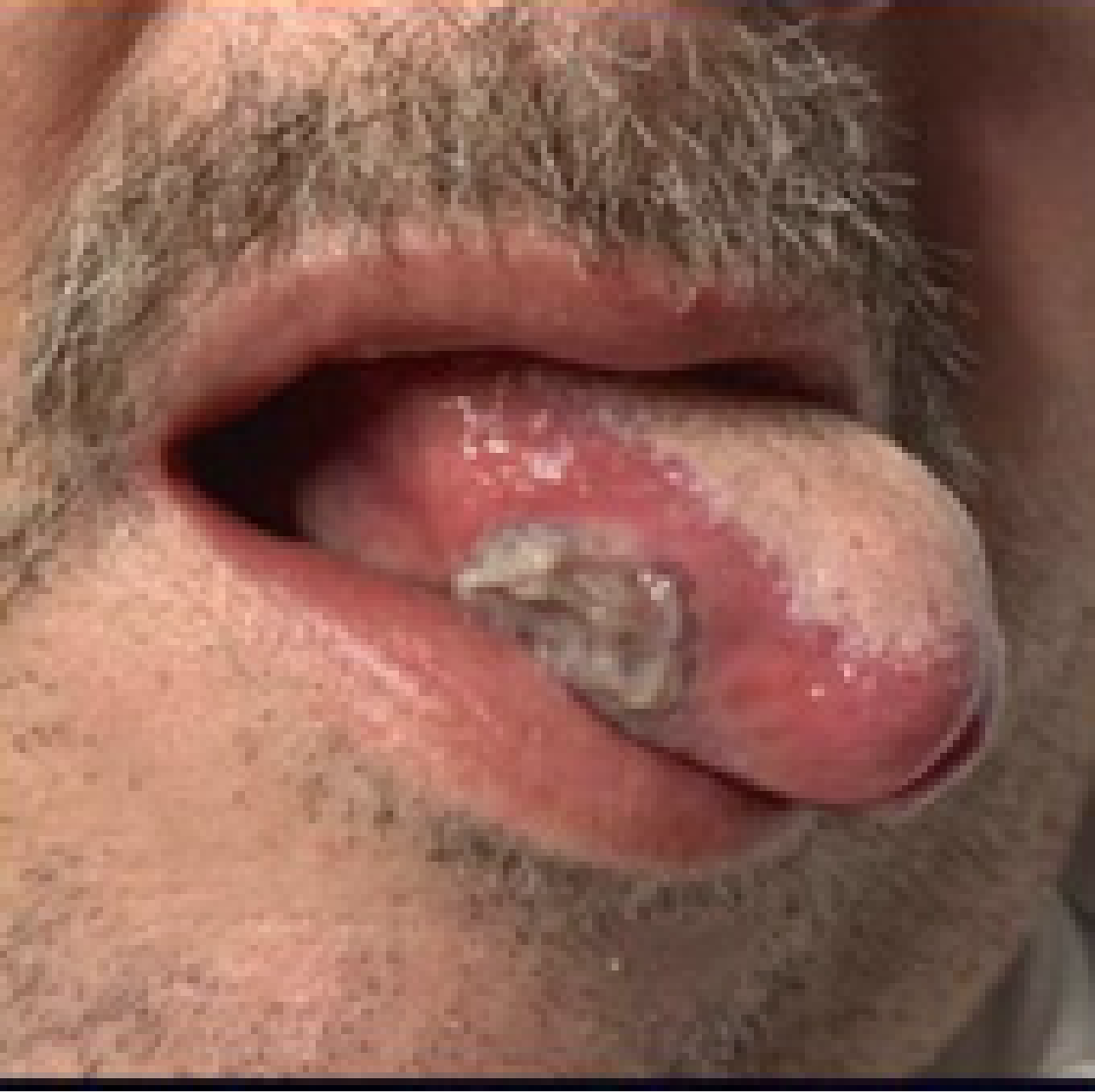 GPA/MPA symptoms: Mucous membrane - tongue ulcer