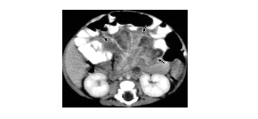 intra-abdominal-infection-cgd-ct-scan-mobile
