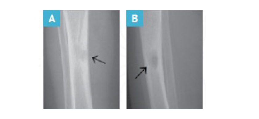osteomyelitis-cgd-xray-image