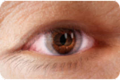 diplopia