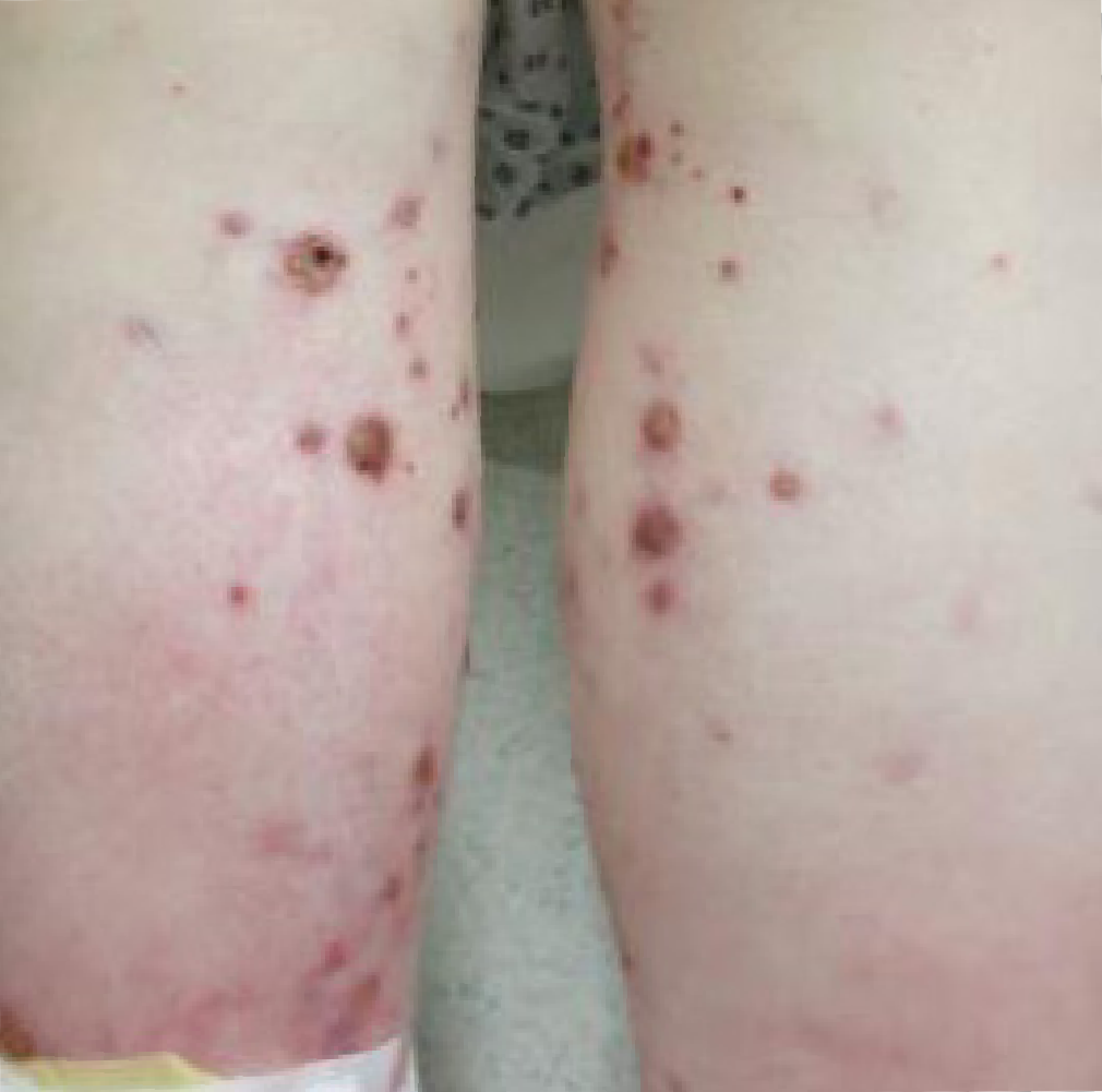 GPA/MPA symptoms: Severe skin purpura