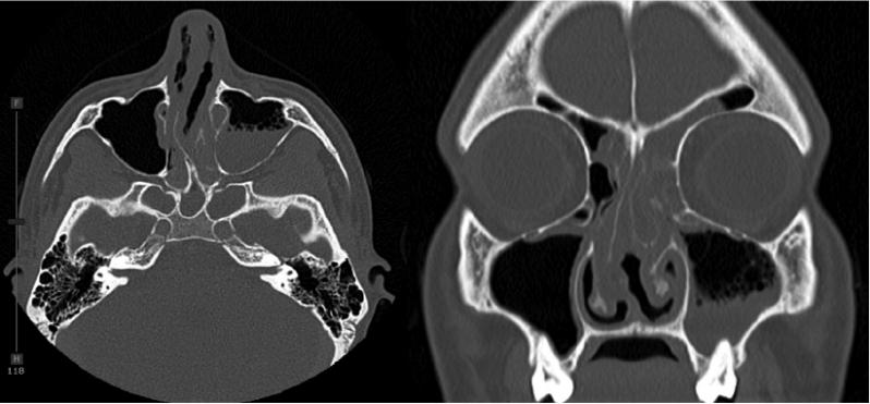 CT scan revealing complete opacification of left front and left sphenoid sinus