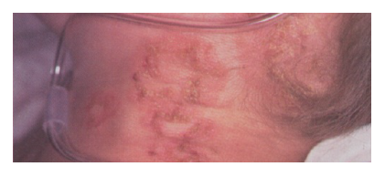 vesicular-lesions-x-linked-cgd-neck