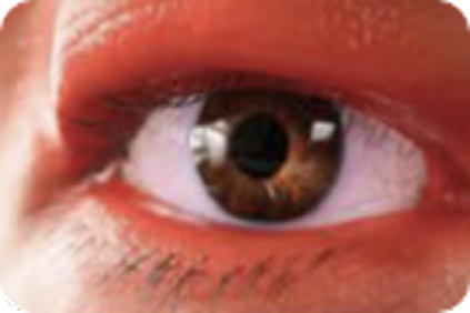erythema, edema, and tearing