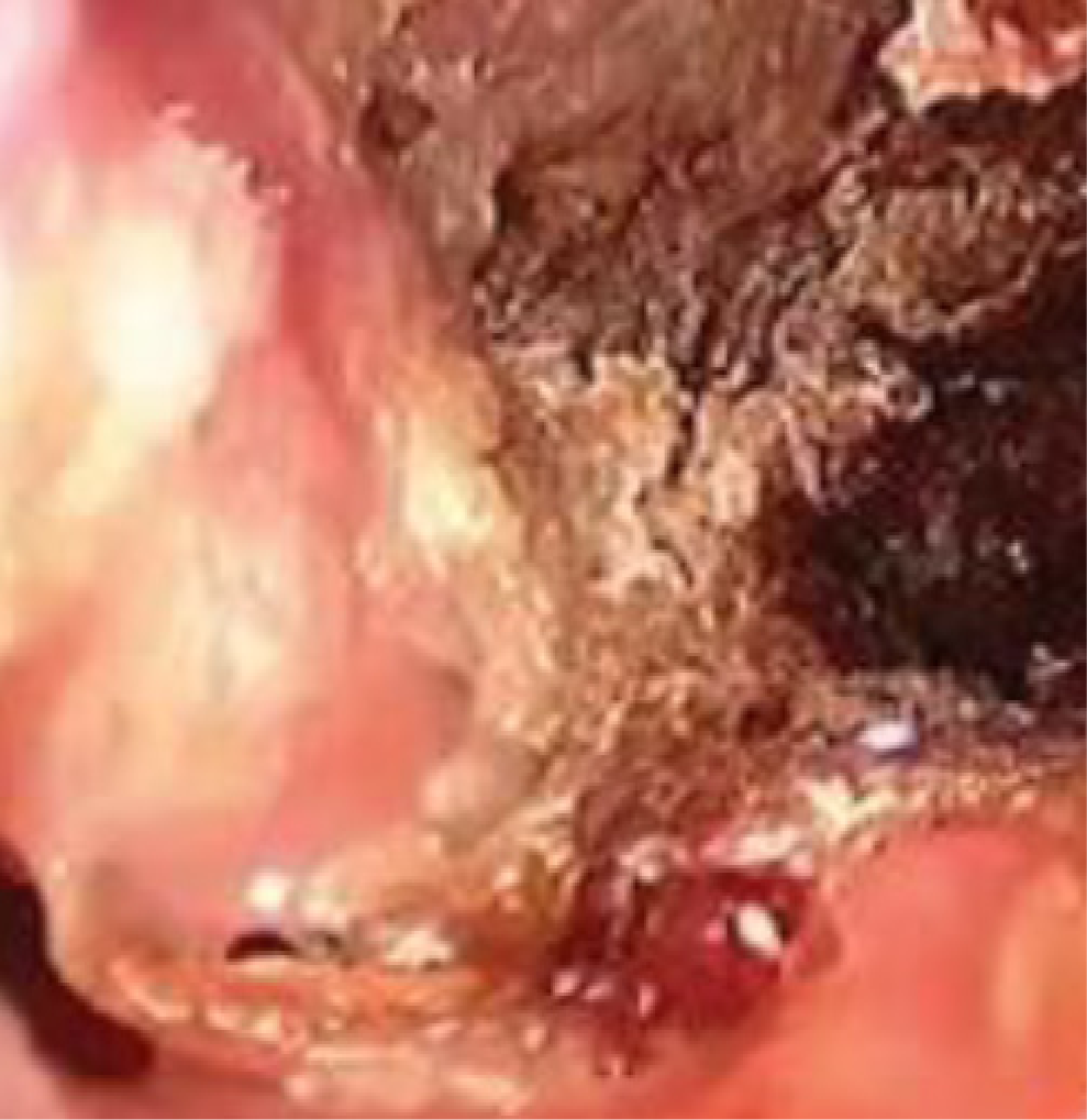 GPA/MPA symptoms: ENT - crusted nasal ulcers with prior septal perforation