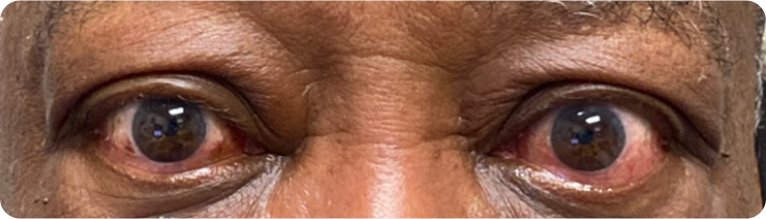 PRE-TREATMENT