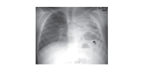 pulmonary-infection-cgd-xray-image-mobile