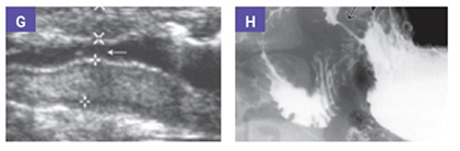 gastric-outlet-obstruction-cgd-imaging