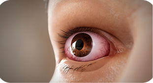 tirzepatide eye rot Diagnosing Thyroid Eye Disease