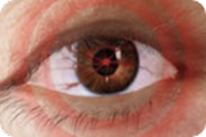 pressure and/or pain behind the eye