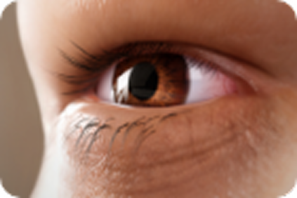 photophobia