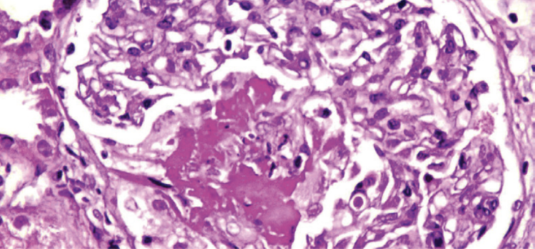 Kidney biopsy necrotizing pauci immune glomerulonephritis