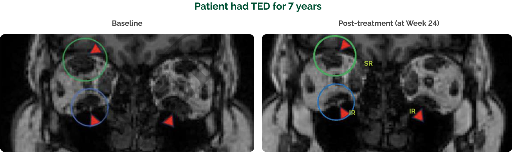 Orbital MRI of a patient from the Phase 4 study