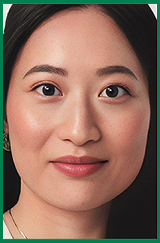 Lily, a real TEPEZZA® patient with thyroid eye disease (TED), after 8 infusions of TEPEZZA® treatment
