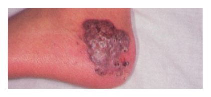 cutaneous-aspergillosis-granulomatous-plaque-cgd