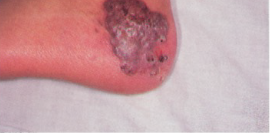 cutaneous-aspergillosis-granulomatous-plaque-cgd-mobile