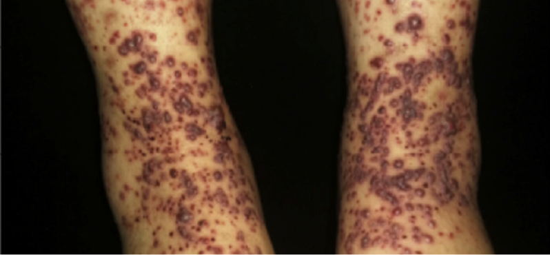 Bilateral lower extremity purpura