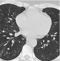 chest-bilateral