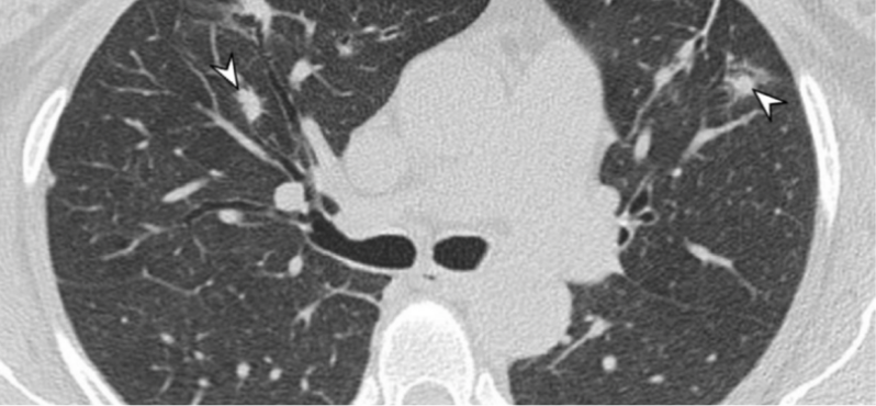 Chest CT showing multiple bilateral nodules and masses, extensive at the bases