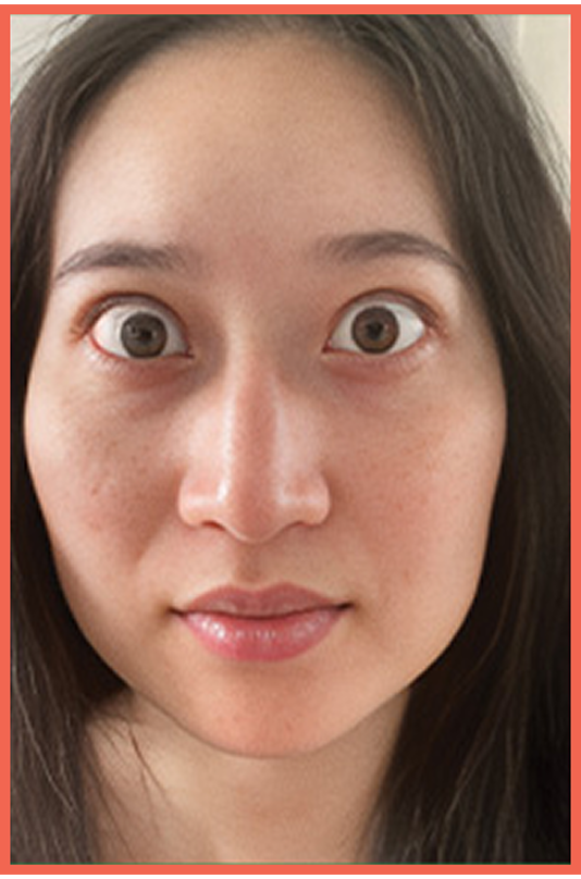 Lily, a real TEPEZZA® patient with thyroid eye disease (TED) before TEPEZZA® treatment