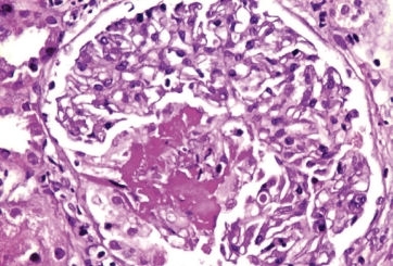 kidney-biopsy