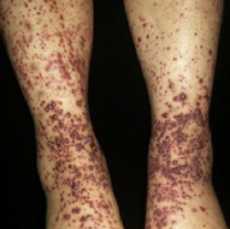 leg-infection