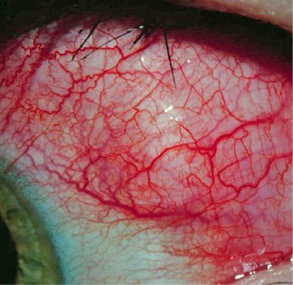 GPA/MPA symptoms: Eyes - scleritis