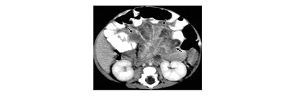intra-abdominal-infection-cgd-ct-scan