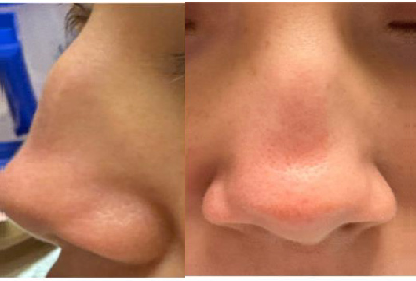 GPA/MPA symptoms: Nasal/paranasal manifestations